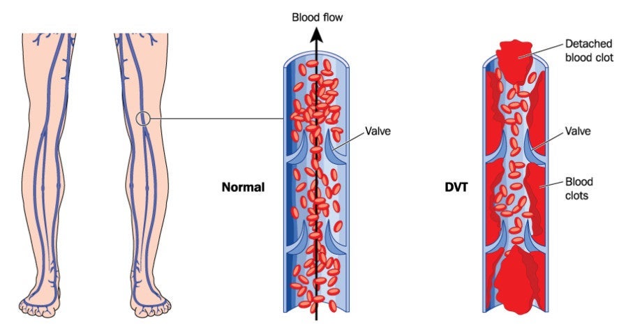 How deep vein thrombosis (DVT) happens. When the blood clot from DVT reaches the lung, that's a pulmonary embolism.