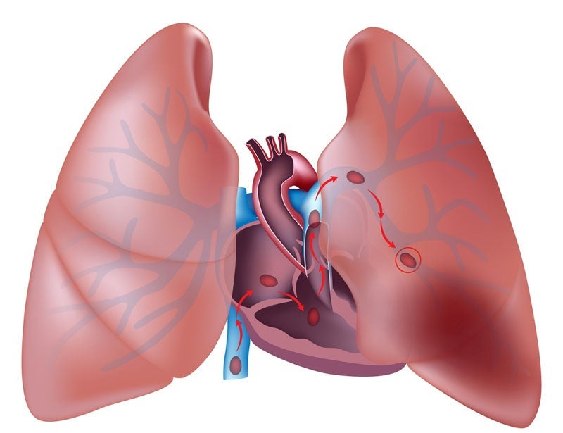An undetected embolism can travel to the lung — a condition that is often fatal. Photo courtesy of Shutterstock.