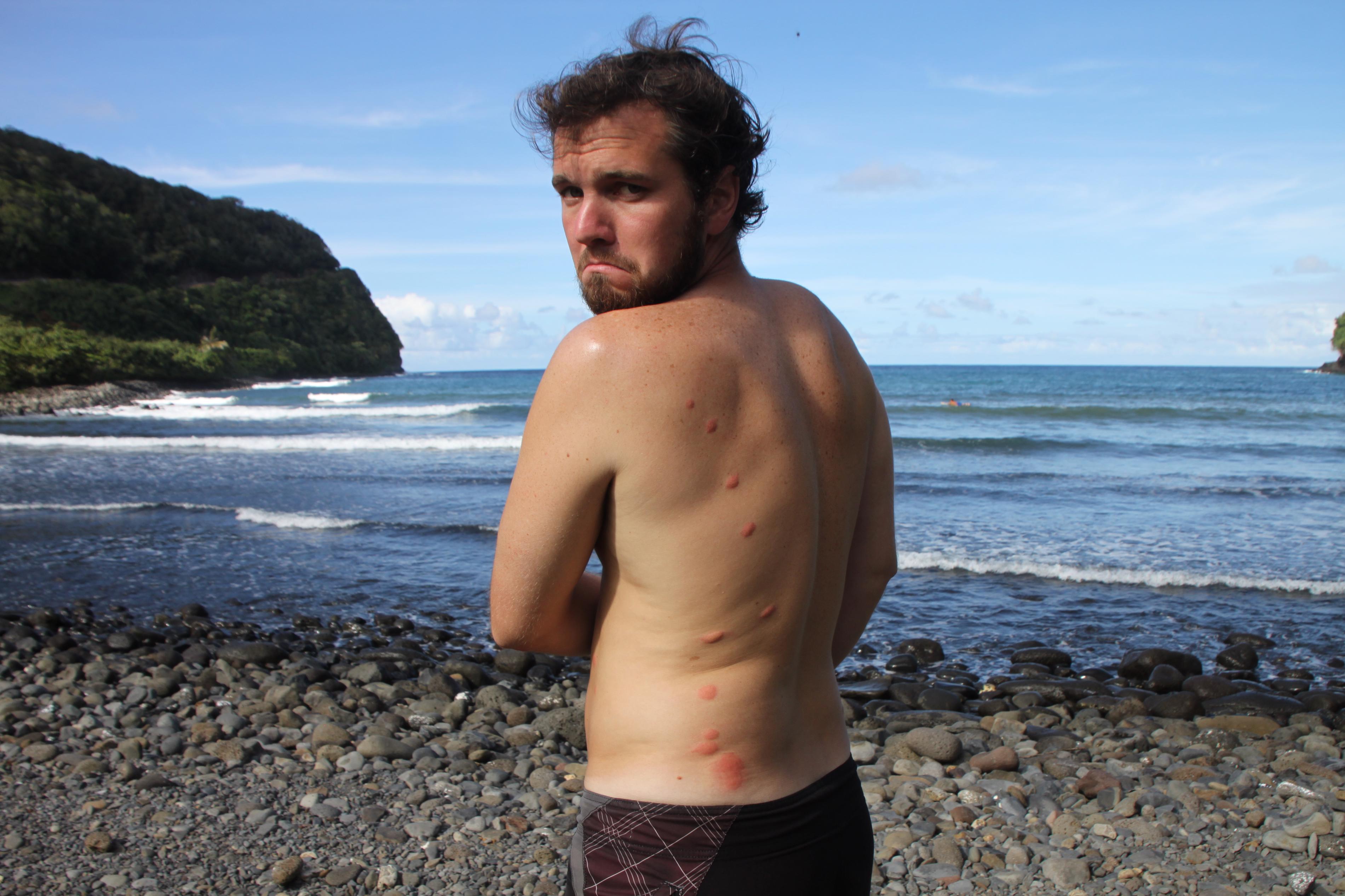 From my first and worst bed bug attack - a hostel in Maui in 2010.